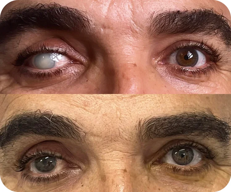 Ceratopigmentação terapêutica antes e depois — resultado 1