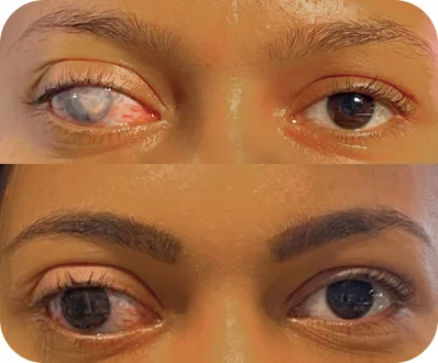Ceratopigmentação terapêutica antes e depois — resultado 2