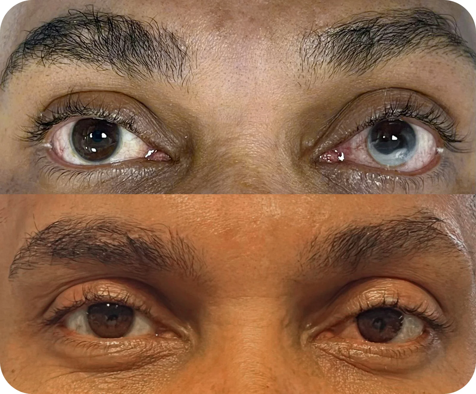 Ceratopigmentação terapêutica antes e depois — resultado 3
