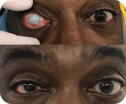 Ceratopigmentação terapêutica antes e depois — resultado 4